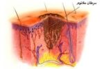اینفوگرافیک / پنج ماده غذایی برای کمک به پیشگیری از سرطان پوست