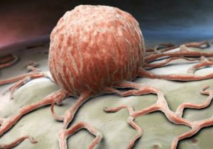 علائم هشداردهنده سرطان که مردان آن‌ها را نادیده می‌گیرند