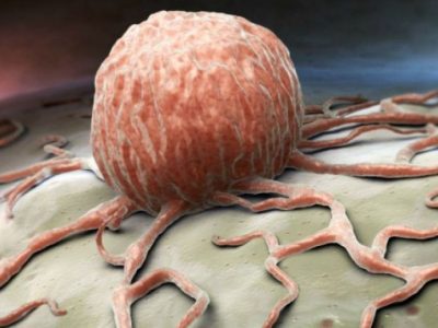 علائم هشداردهنده سرطان که مردان آنها را نادیده میگیرند