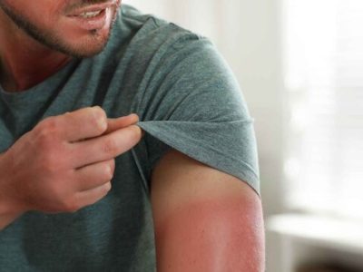 خطر بروز سرطان با آفتابسوختگی/ توصیههایی برای مراقبت از پوست در گرما