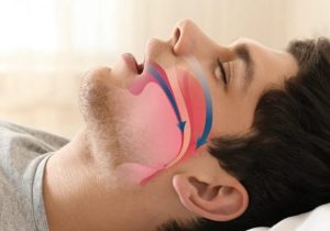 چگونه خروپف را درمان کنیم؟