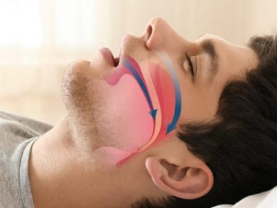 چگونه خروپف را درمان کنیم؟