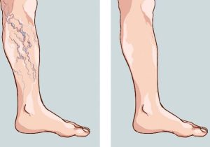 رگهای واریسی؛ عارضه جانبی شایع چاقی