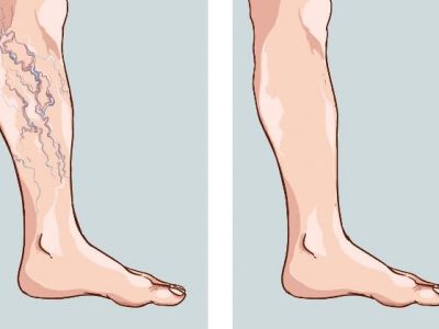 رگهای واریسی؛ عارضه جانبی شایع چاقی