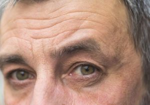 چین و چروک‌های صورت درباره کدام بیماری‌ها هشدار می‌دهند؟