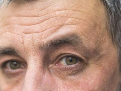 چین و چروک‌های صورت درباره کدام بیماری‌ها هشدار می‌دهند؟