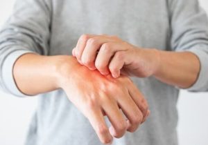 علت خارش شدید پوست و درمان فوری آن چیست؟