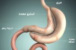 خطرات و مزایای جراحی اسلیو معده برای چاق‌ها / چه افرادی می‌توانند این جراحی را انجام دهند؟