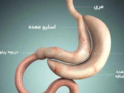 خطرات و مزایای جراحی اسلیو معده برای چاقها / چه افرادی میتوانند این جراحی را انجام دهند؟
