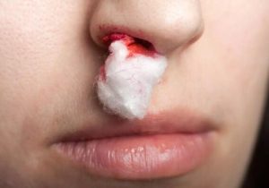 شایع‌ترین علل خونریزی بینی؛ چه زمانی به پزشک مراجعه کنیم؟