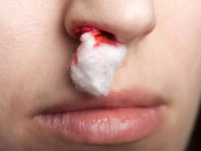 شایع‌ترین علل خونریزی بینی؛ چه زمانی به پزشک مراجعه کنیم؟