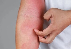 چگونه از شر خارش و التهاب در فصل بهار رها شویم؟
