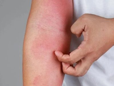 چگونه از شر خارش و التهاب در فصل بهار رها شویم؟