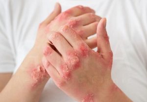 ۷ نشانه‌ پوستی که خبر از بیماری جدی می‌دهند