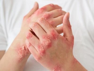 ۷ نشانه‌ پوستی که خبر از بیماری جدی می‌دهند