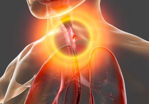 درباره سرطان مری؛ یک سرطان شایع در ایران