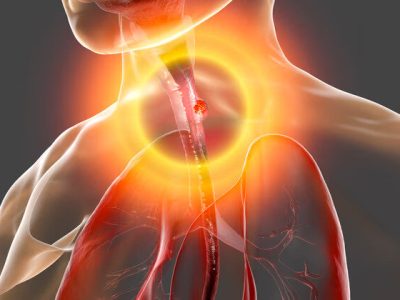 درباره سرطان مری؛ یک سرطان شایع در ایران